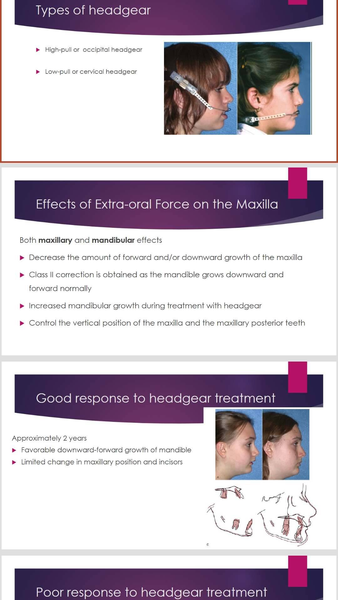 1573145634 4425 - پاورپوینت انگلیسی extra oral force headgear